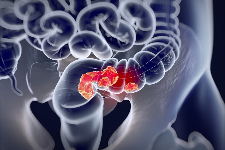 Colorectal Cancer Screening: Tests & Guidelines Guide